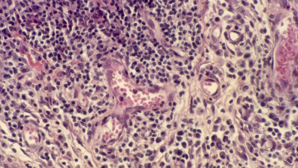 Artiva Biotherapeutics halts development of autoimmune cell therapy following two patient deaths in clinical trial